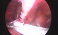 Traitement laparoscopique de la hernie inguinale