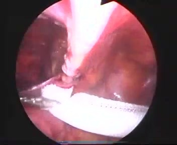 Traitement laparoscopique de la hernie inguinale