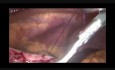 RésectionIntragastrique Laparoscopique (RIGL) : Comment Je Procède?