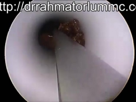 Comment Evacuer les Croûtes Durcies d'un Tube en T Obstrué