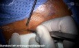 Left Standard Retrosigmoid Craniotomy and ABI Insertion