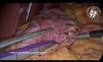 Gastrectomie Sleeve en cas de Pneumatose Intestinale