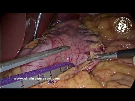 Gastrectomie Sleeve en cas de Pneumatose Intestinale