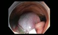 Coloscopie compliquée - saignement du côlon ascendant lors d'une mucosectomie endoscopique - Cas 1A