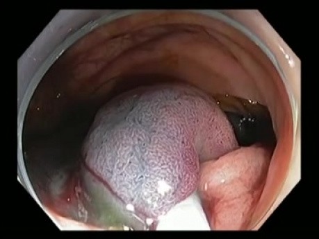 Coloscopie compliquée - saignement du côlon ascendant lors d'une mucosectomie endoscopique - Cas 1A