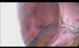 Anastomose Intracorporelle: Hémicolectomie Droite Laparoscopique 