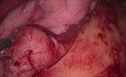 Gastrectomie Sleeve: Hémostase