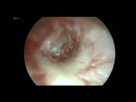 Tympanoplastie Endoscopique du Cartilage de Type I