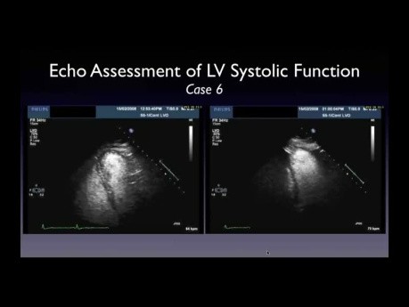 Une Approche Pratique de la Fraction d'Ejection Ventriculaire gauche (FEVG) en Echocardiographie