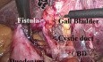 Fistule cholécystoduodénale