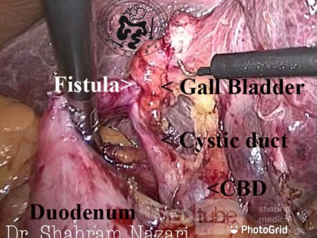 Fistule cholécystoduodénale