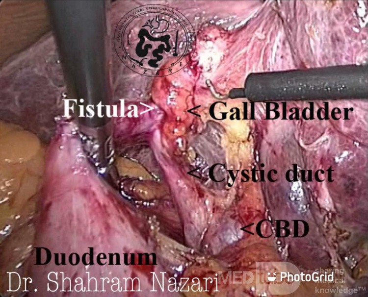 Fistule cholécystoduodénale