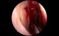 Chirurgie Transsphénoïdale Transnasale pour Macroadénome Hypophysaire Géant avec Elévation du Lambeau Nasoseptal
