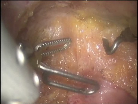 Excision Mésorectale Totale Robotisée - Solution Pratique