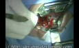 Amygdalectomie par méthode de dissection