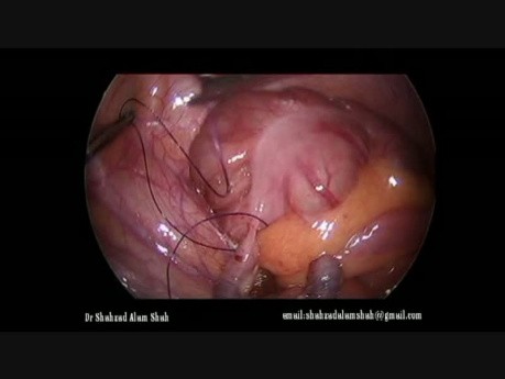 Appendicectomie par voie laparoscopique