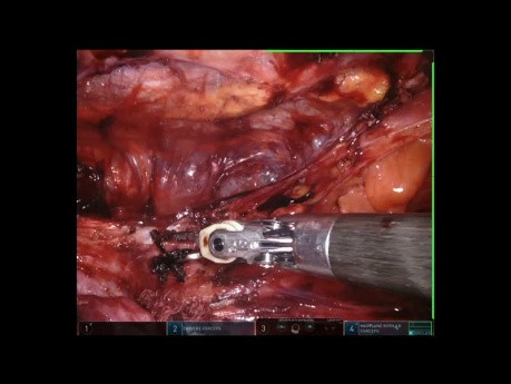 Résection robotique d'une tumeur germinale du médiastin (après une chimiothérapie)