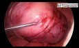 Chirurgie laparoscopique pour les gros fibromes ligamentaires larges