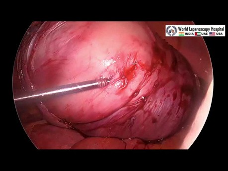 Chirurgie laparoscopique pour les gros fibromes ligamentaires larges