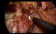 Conversion Fundoplicature de Nissen  en Roux-en-Y Gastric Bypass