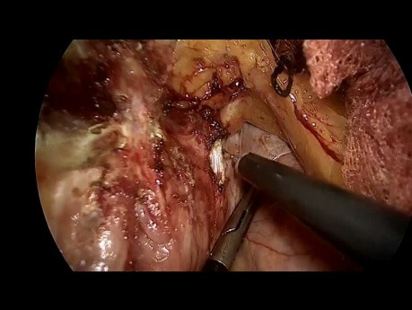 Conversion Fundoplicature de Nissen  en Roux-en-Y Gastric Bypass