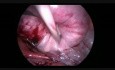 Myomectomie laparoscopique d'un fibrome dans le ligament large