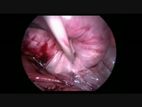 Myomectomie laparoscopique d'un fibrome dans le ligament large