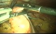 La laparoscopie conventionnelle à la fundoplication laparo-endoscopique à site unique le parcours du RGO (reflux gastro-oesophagien)