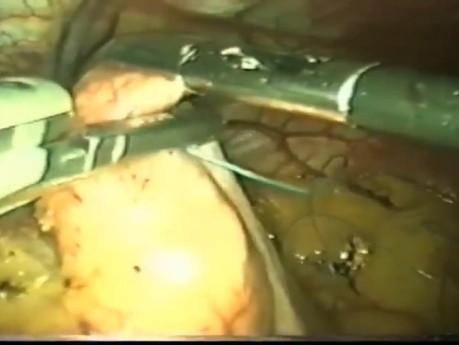 La laparoscopie conventionnelle à la fundoplication laparo-endoscopique à site unique le parcours du RGO (reflux gastro-oesophagien)