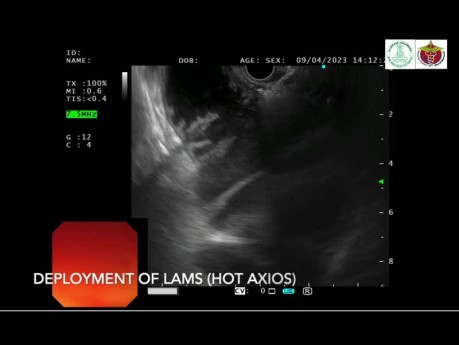 Syndrome de l'Anse Afférente dû à une Obstruction Maligne Traité par la Gastrojéjunostomie LAMS guidée par l'Echo-endoscopie