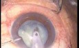 Phacoémulsification, technique du stop-and-chop, cataracte blanche