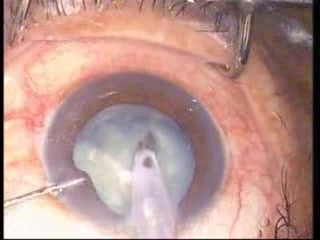 Phacoémulsification, technique du stop-and-chop, cataracte blanche