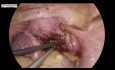 Myomectomie laparoscopique pour fibrome de la paroi postérieure de l'utérus avec endométriose