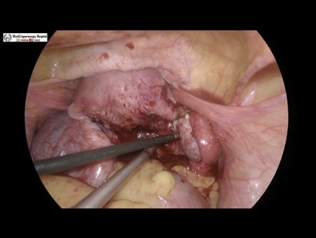 Myomectomie laparoscopique pour fibrome de la paroi postérieure de l'utérus avec endométriose