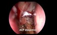 Chirurgie Endoscopique des Sinus pour l'Excision des Polypes Antrochoanaux Maxillaires