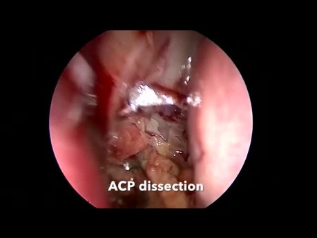 Chirurgie Endoscopique des Sinus pour l'Excision des Polypes Antrochoanaux Maxillaires