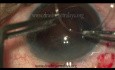 Cataracte traumatique avec subluxation du cristallin