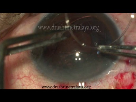 Cataracte traumatique avec subluxation du cristallin