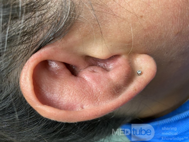 Périchondrite du pavillon de l'oreille