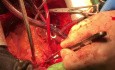 Conseils Techniques pour Transplantation Cardiaque 