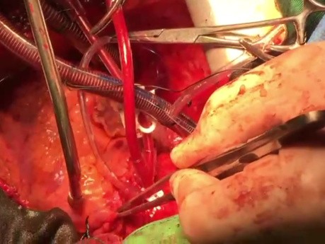 Conseils Techniques pour Transplantation Cardiaque 