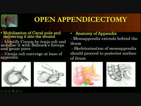 Appendicectomie ouverte