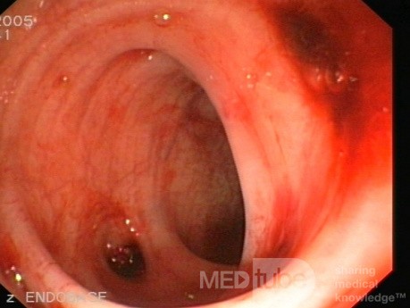 L'hémorragie diverticulaire.