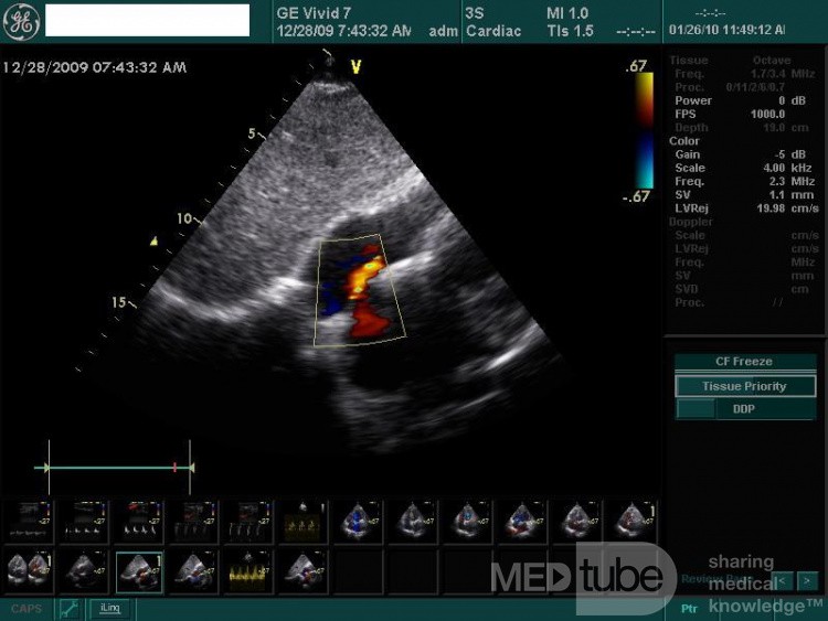 Le foramen ovale perméable (FOP)