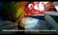 Réparation de la dissection aortique aiguë de type A