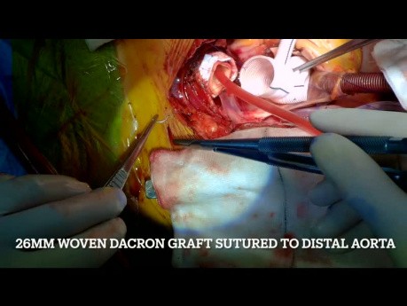 Réparation de la dissection aortique aiguë de type A