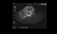 Lithiase cholédocienne sans dilatation du cholédoque, écho-endoscopie