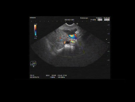 Lithiase cholédocienne sans dilatation du cholédoque, écho-endoscopie