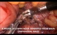 Biopsie laparoscopique des ganglions lymphatiques para-aortiques