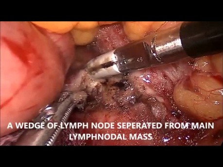 Biopsie laparoscopique des ganglions lymphatiques para-aortiques